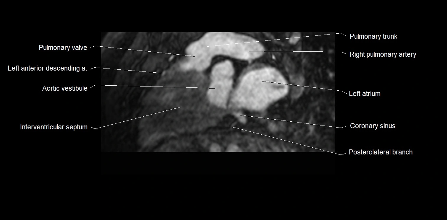 MRI heart and coronary arteries two chamber(sagittal)  anatomy image 21.webp